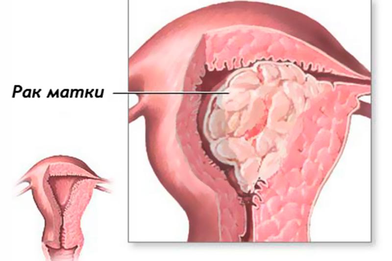 Рак тела матки: причины, симптомы, диагностика и лечение